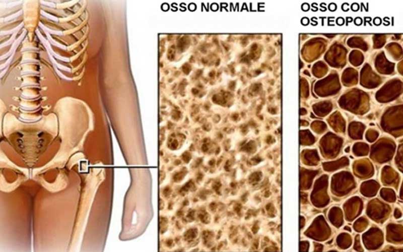 OSTEOPOROSI